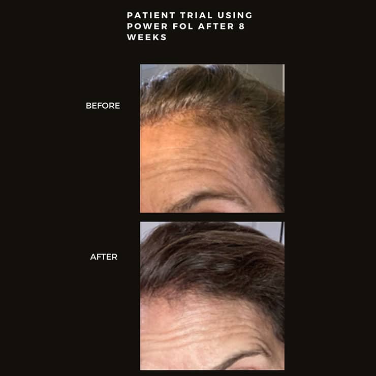 Patient trial after power fol after 8 weeks