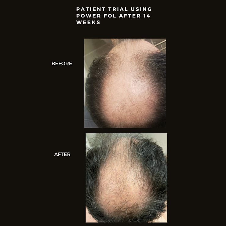 Patient trial using power fol after 14 weeks